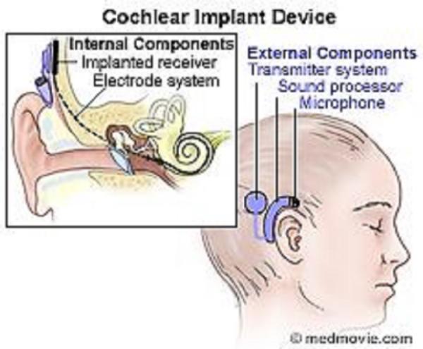 Cochlear Implants How Are They Different From Hearing Aids Temple